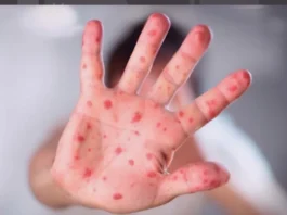 Se duplican los casos de sarampión y Santa Cruz es el epicentro. FOTO: Captura de pantalla.